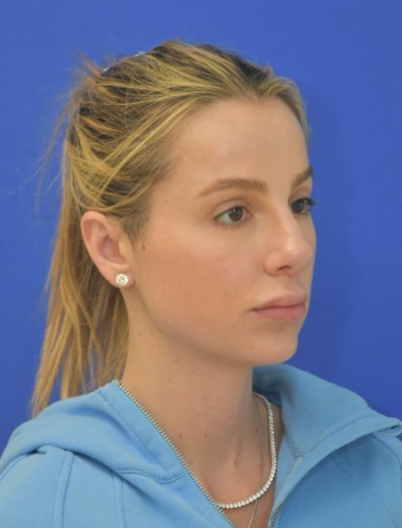 Rhinoplasty Before & After Gallery - Patient 383704 - Image 4