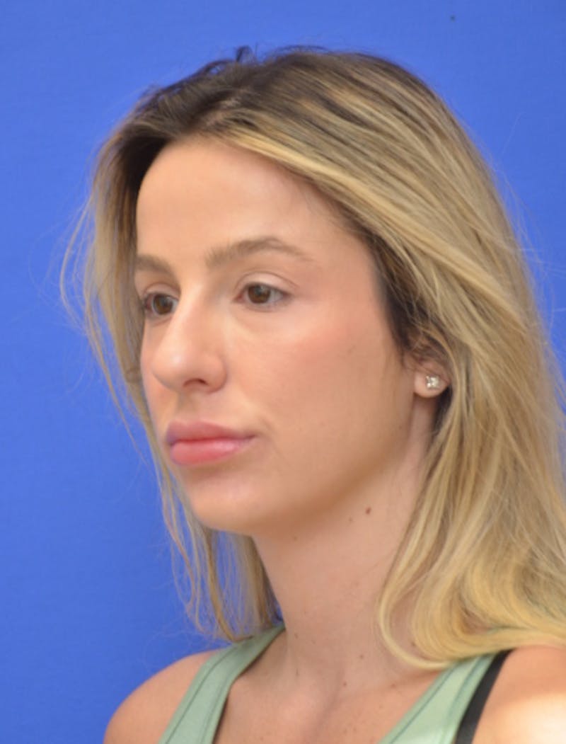 Rhinoplasty Before & After Gallery - Patient 383704 - Image 5