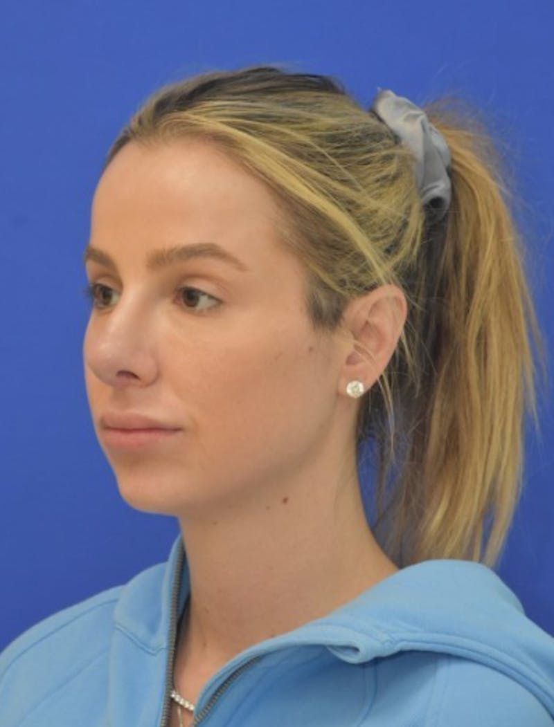 Rhinoplasty Before & After Gallery - Patient 383704 - Image 6