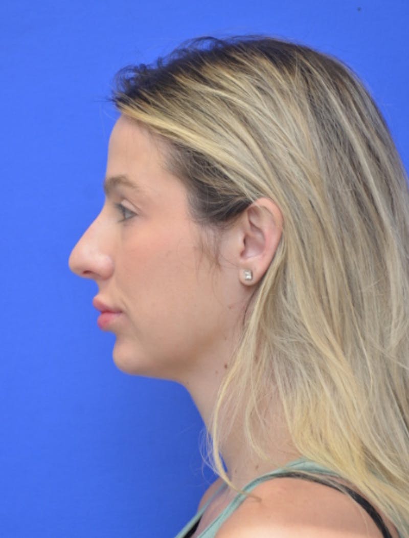 Rhinoplasty Before & After Gallery - Patient 383704 - Image 7