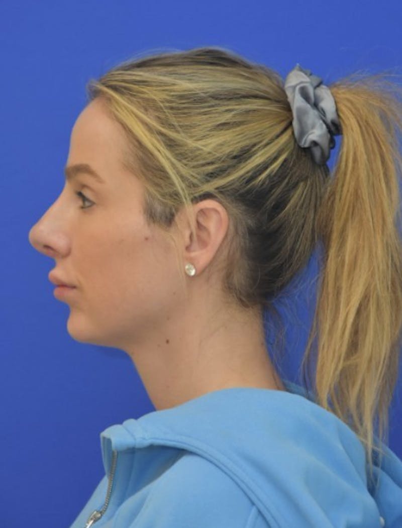 Rhinoplasty Before & After Gallery - Patient 383704 - Image 8