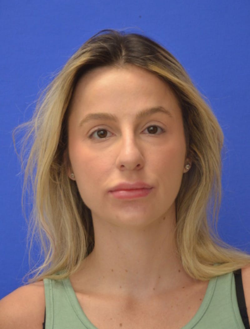 Rhinoplasty Before & After Gallery - Patient 383704 - Image 9