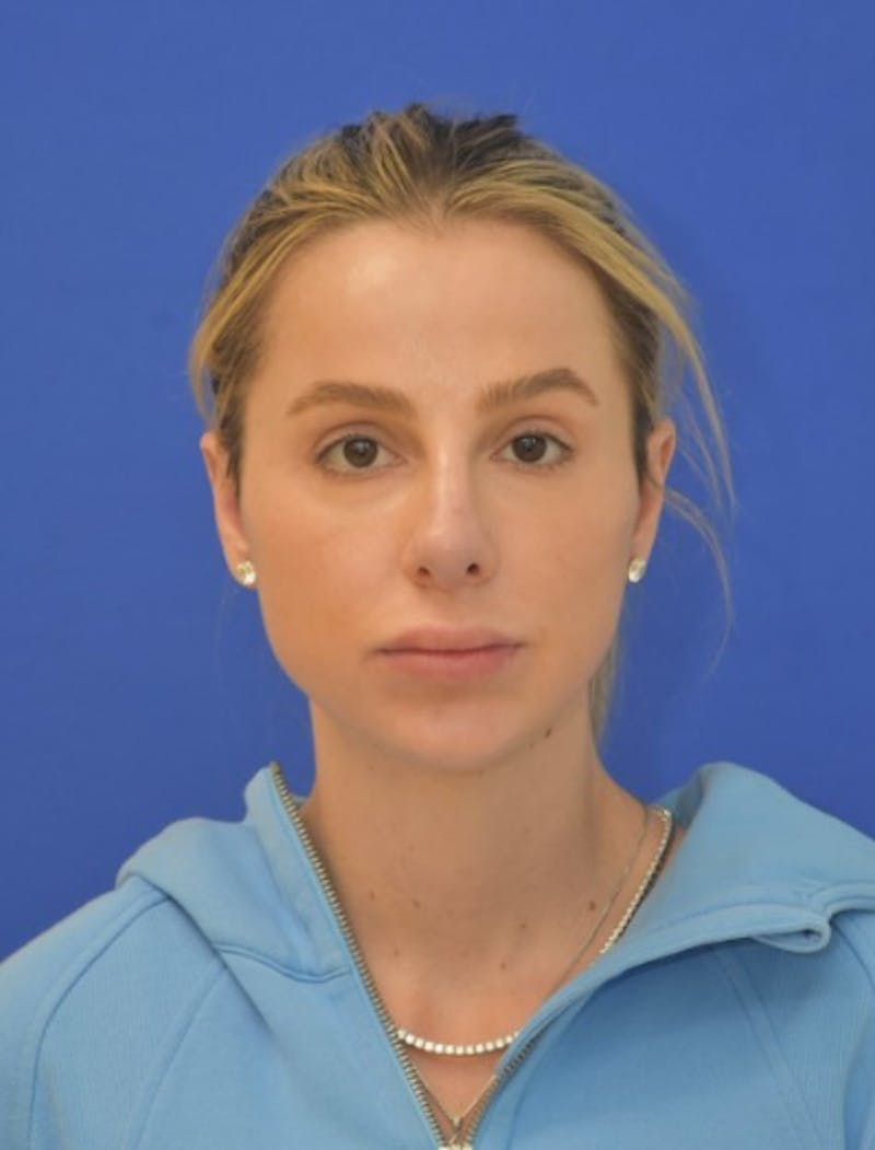 Rhinoplasty Before & After Gallery - Patient 383704 - Image 10