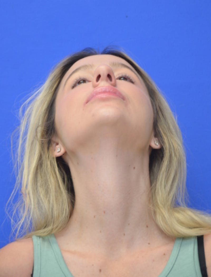 Rhinoplasty Before & After Gallery - Patient 383704 - Image 11