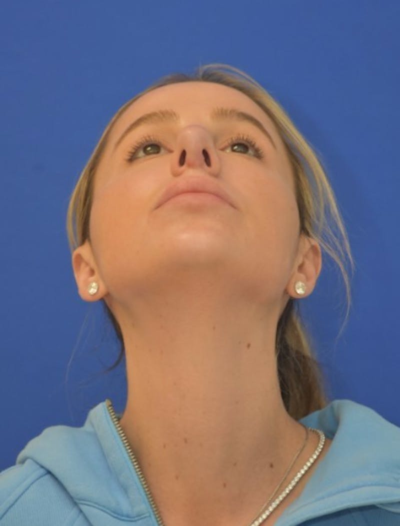 Rhinoplasty Before & After Gallery - Patient 383704 - Image 12