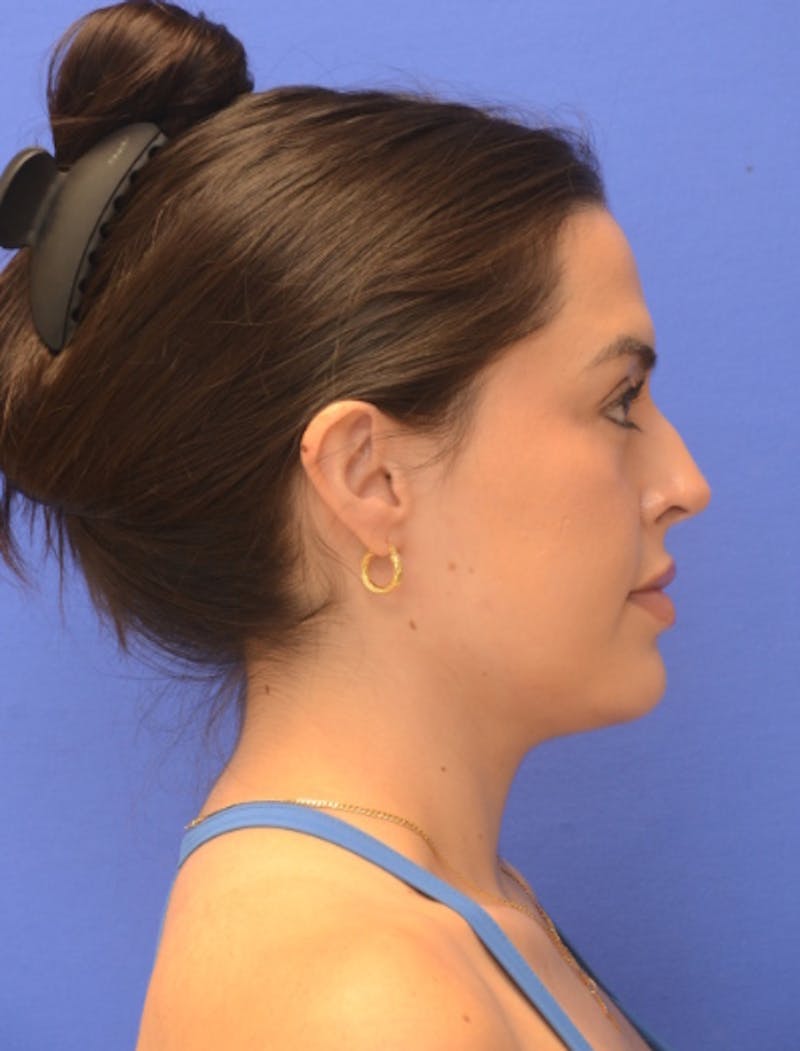 Rhinoplasty Before & After Gallery - Patient 407801 - Image 1