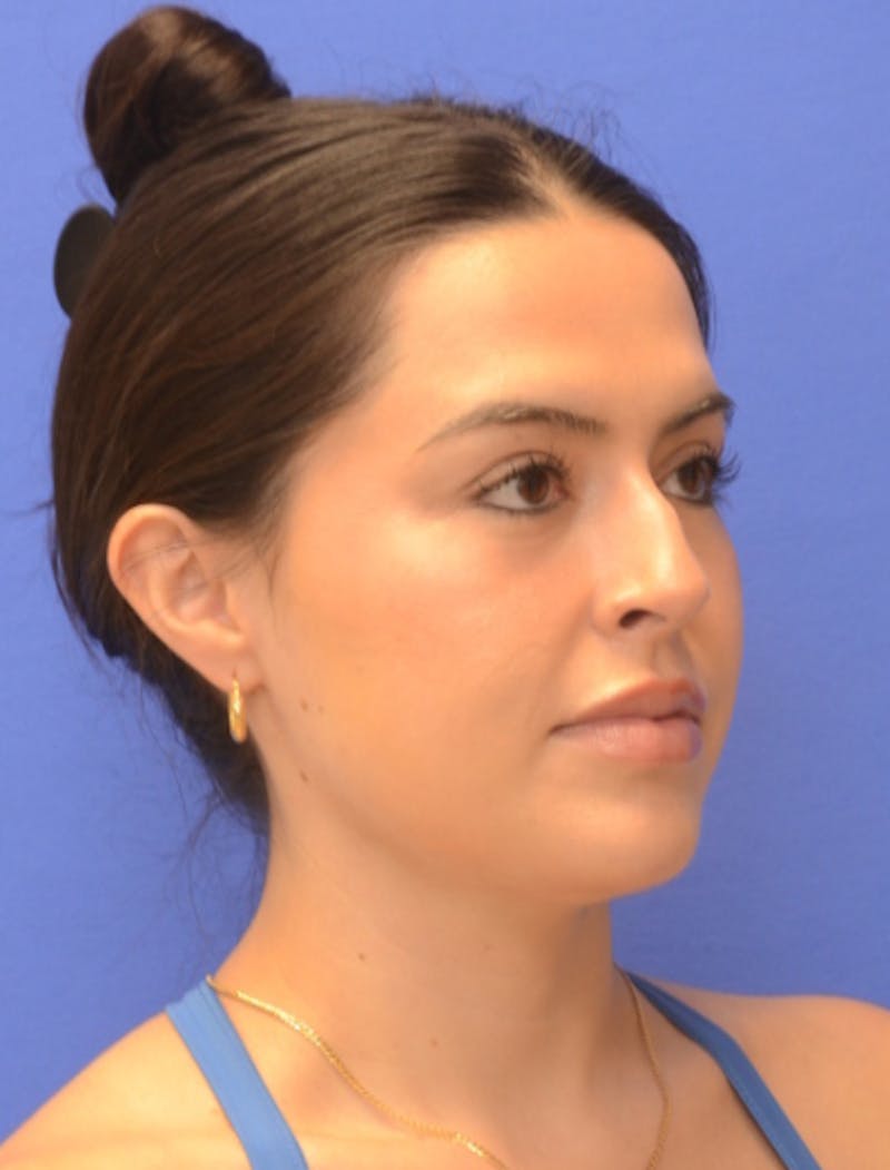 Rhinoplasty Before & After Gallery - Patient 407801 - Image 3