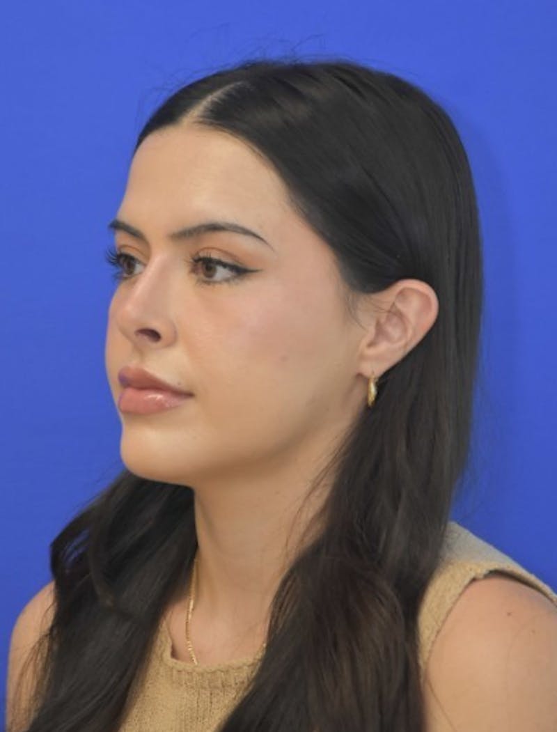 Rhinoplasty Before & After Gallery - Patient 407801 - Image 6