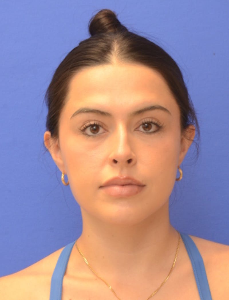 Rhinoplasty Before & After Gallery - Patient 407801 - Image 9