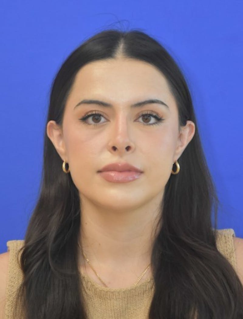 Rhinoplasty Before & After Gallery - Patient 407801 - Image 10