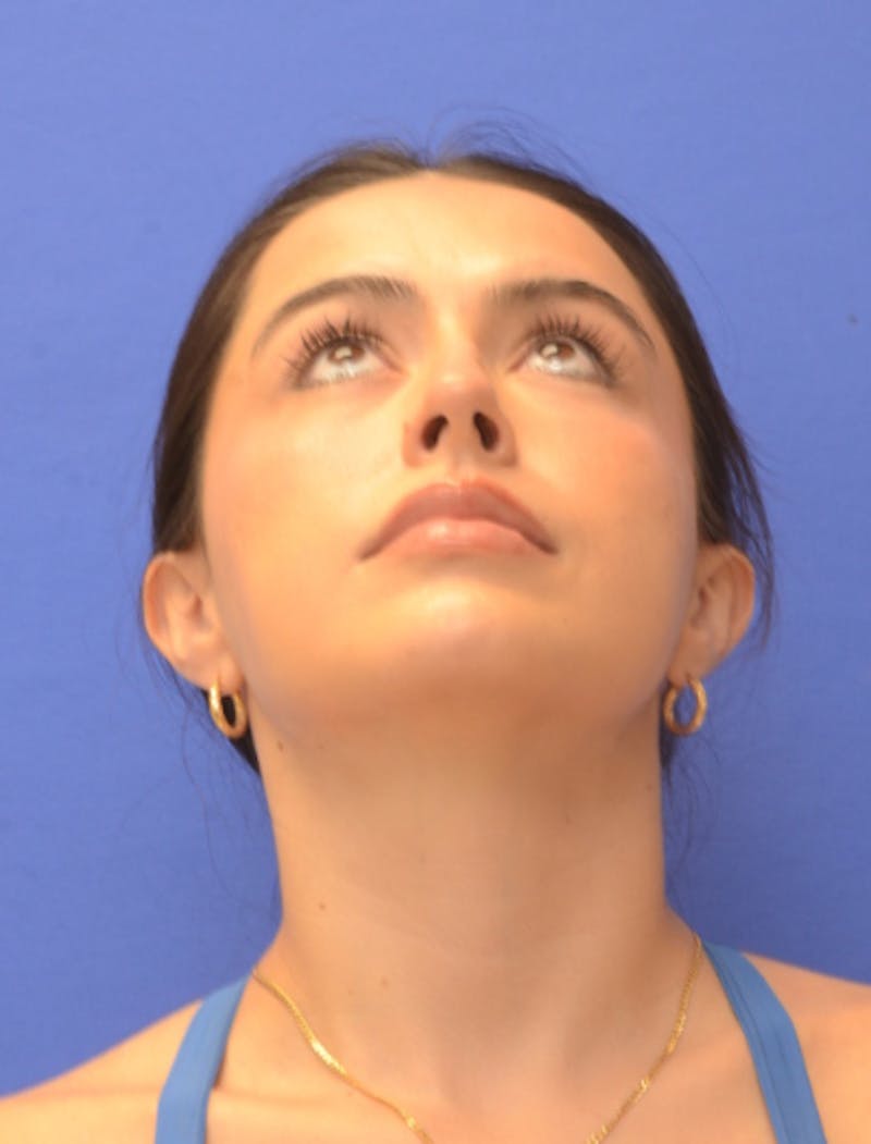 Rhinoplasty Before & After Gallery - Patient 407801 - Image 11