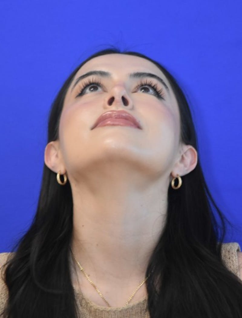 Rhinoplasty Before & After Gallery - Patient 407801 - Image 12