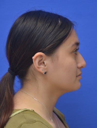 Rhinoplasty Before & After Gallery - Patient 330539 - Image 1