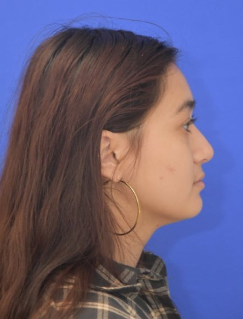 Rhinoplasty Before & After Gallery - Patient 330539 - Image 2