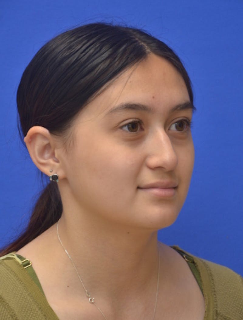 Rhinoplasty Before & After Gallery - Patient 330539 - Image 3