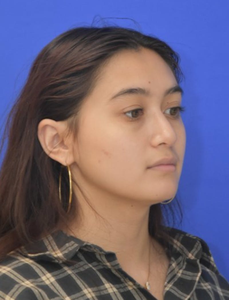 Rhinoplasty Before & After Gallery - Patient 330539 - Image 4