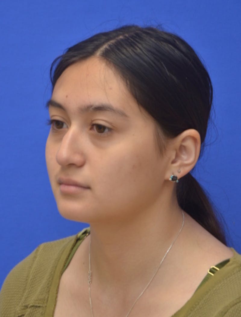 Rhinoplasty Before & After Gallery - Patient 330539 - Image 5