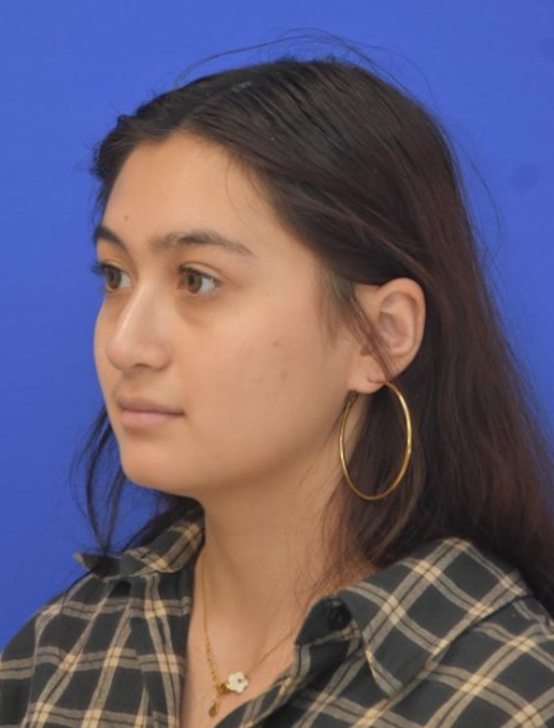 Rhinoplasty Before & After Gallery - Patient 330539 - Image 6