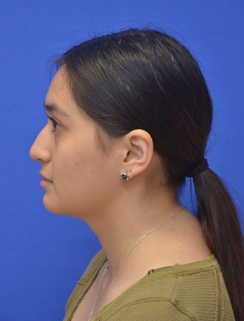 Rhinoplasty Before & After Gallery - Patient 330539 - Image 7