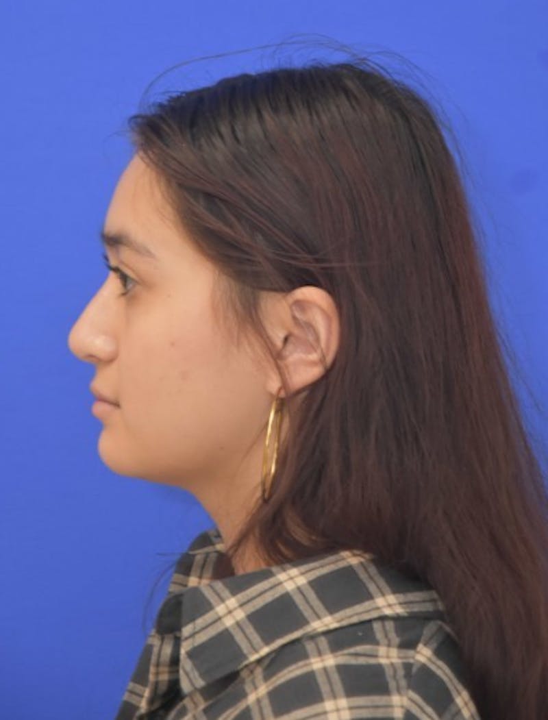 Rhinoplasty Before & After Gallery - Patient 330539 - Image 8