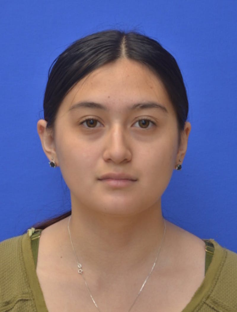 Rhinoplasty Before & After Gallery - Patient 330539 - Image 9