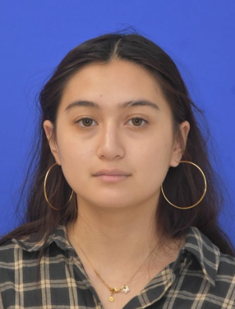 Rhinoplasty Before & After Gallery - Patient 330539 - Image 10