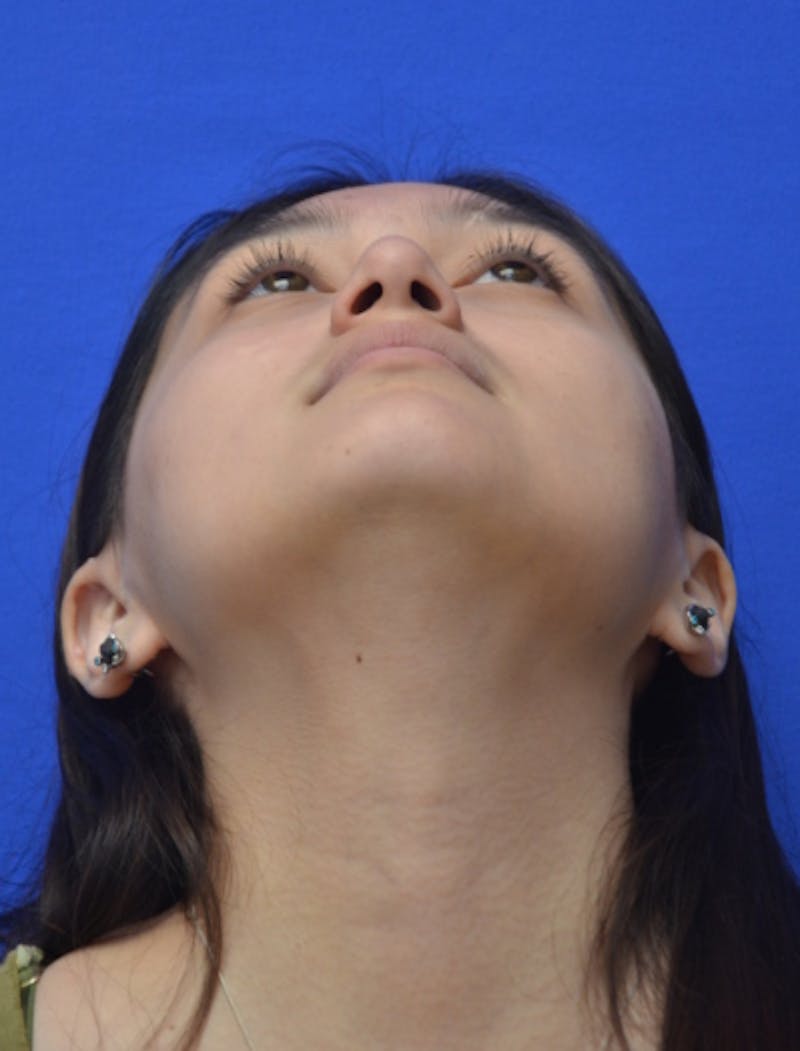 Rhinoplasty Before & After Gallery - Patient 330539 - Image 11