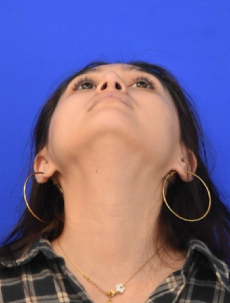 Rhinoplasty Before & After Gallery - Patient 330539 - Image 12