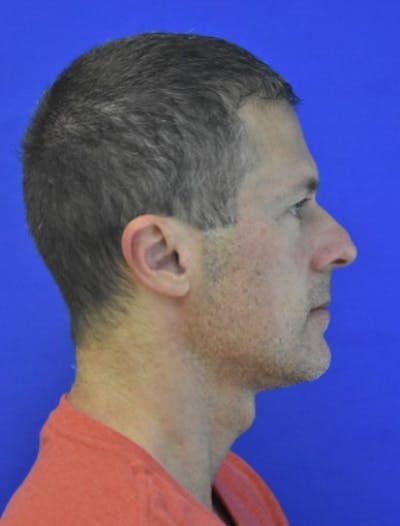 Rhinoplasty Before & After Gallery - Patient 336237 - Image 1