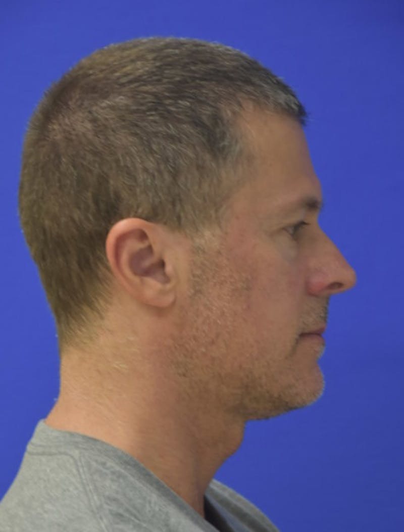 Rhinoplasty Before & After Gallery - Patient 336237 - Image 2