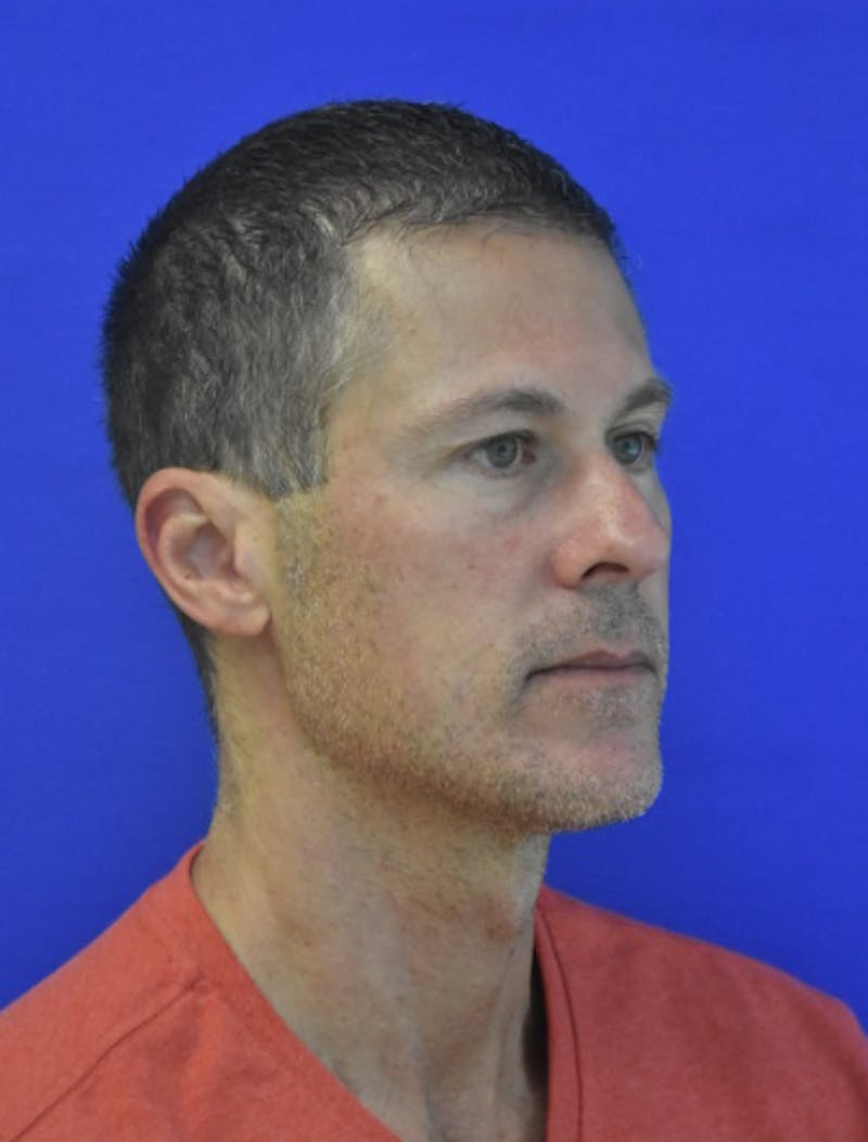 Rhinoplasty Before & After Gallery - Patient 336237 - Image 3