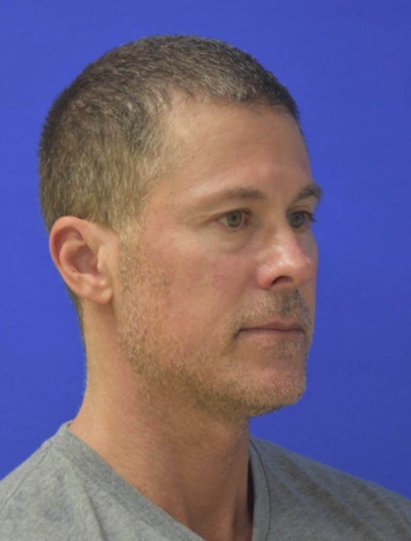 Rhinoplasty Before & After Gallery - Patient 336237 - Image 4