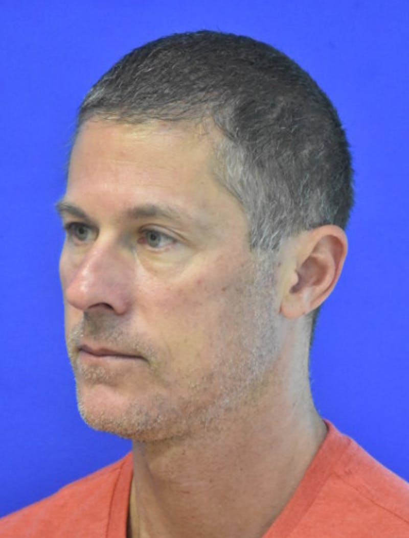 Rhinoplasty Before & After Gallery - Patient 336237 - Image 5