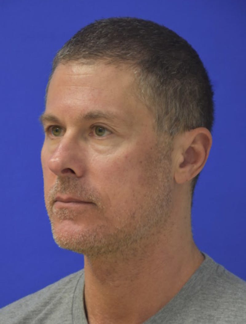 Rhinoplasty Before & After Gallery - Patient 336237 - Image 6