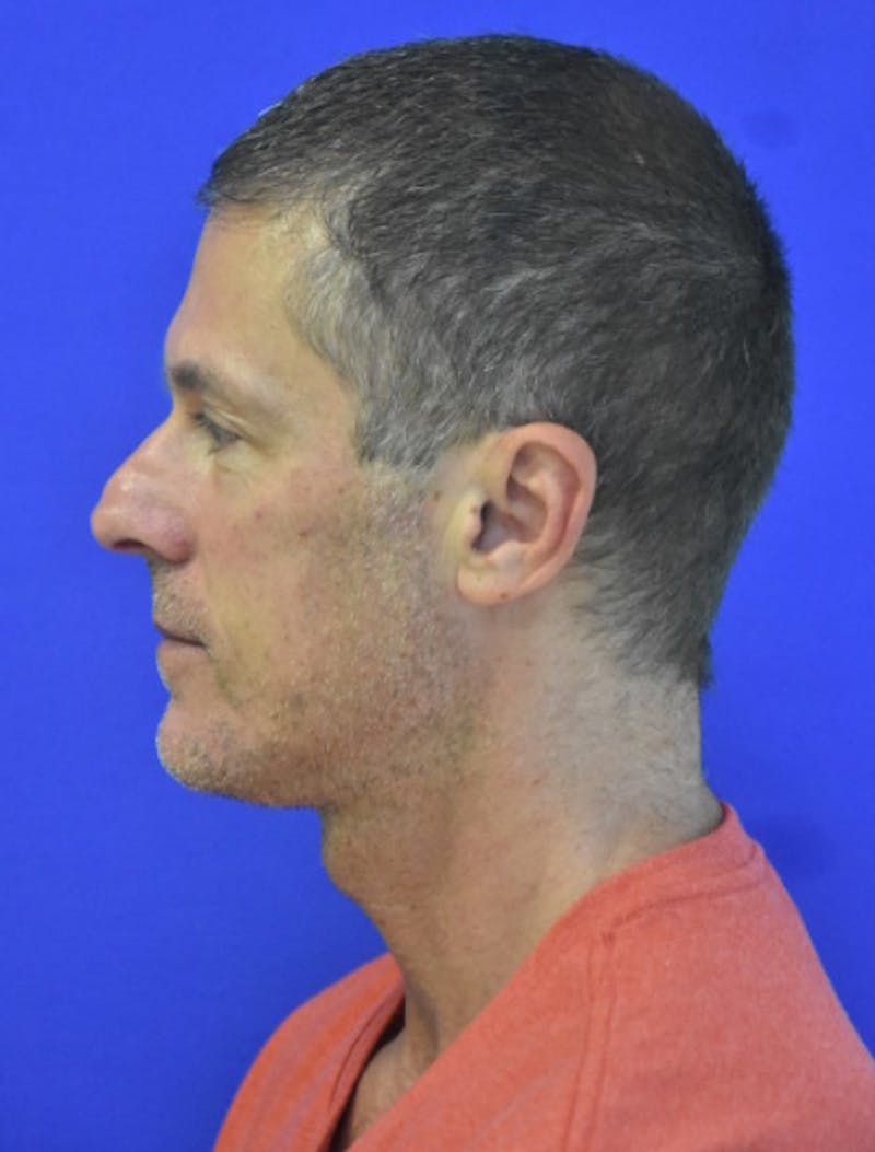 Rhinoplasty Before & After Gallery - Patient 336237 - Image 7