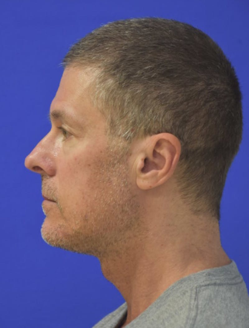Rhinoplasty Before & After Gallery - Patient 336237 - Image 8