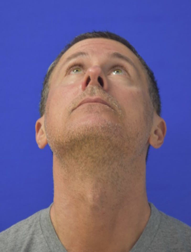 Rhinoplasty Before & After Gallery - Patient 336237 - Image 12
