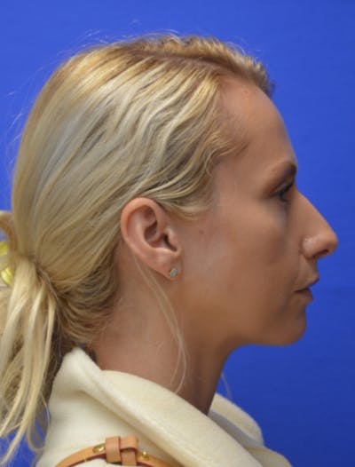 Rhinoplasty Before & After Gallery - Patient 293733 - Image 1