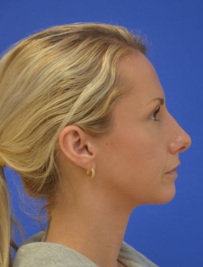 Rhinoplasty Before & After Gallery - Patient 293733 - Image 2