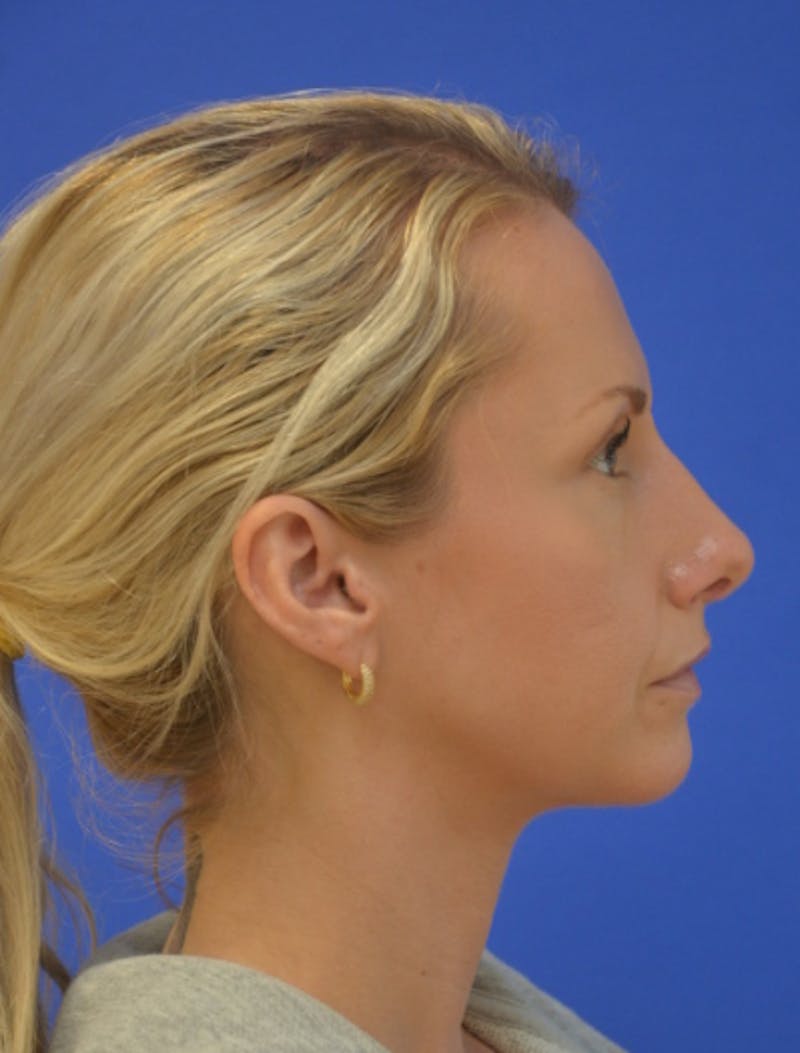 Rhinoplasty Before & After Gallery - Patient 293733 - Image 2