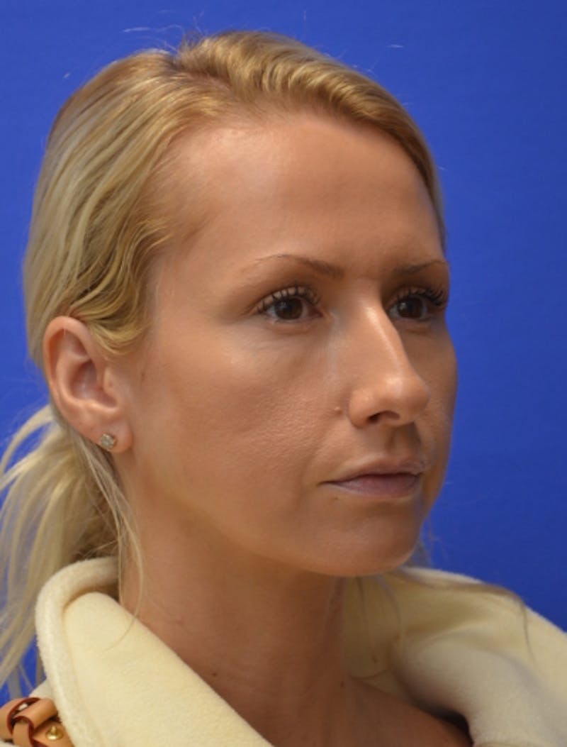 Rhinoplasty Before & After Gallery - Patient 293733 - Image 3