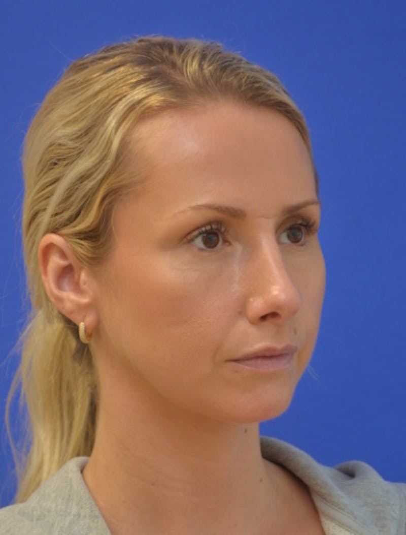 Rhinoplasty Before & After Gallery - Patient 293733 - Image 4