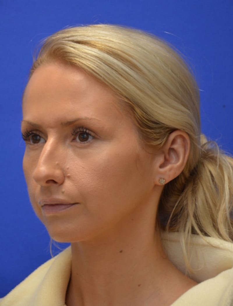 Rhinoplasty Before & After Gallery - Patient 293733 - Image 5