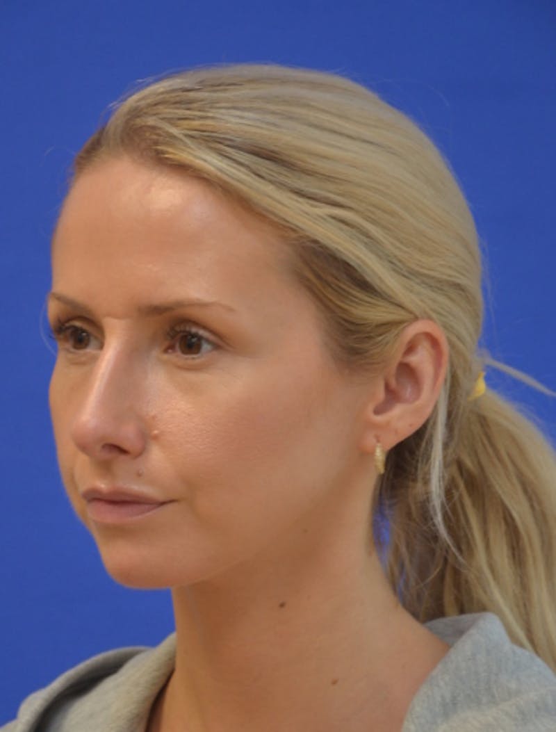 Rhinoplasty Before & After Gallery - Patient 293733 - Image 6