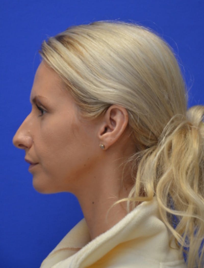 Rhinoplasty Before & After Gallery - Patient 293733 - Image 7
