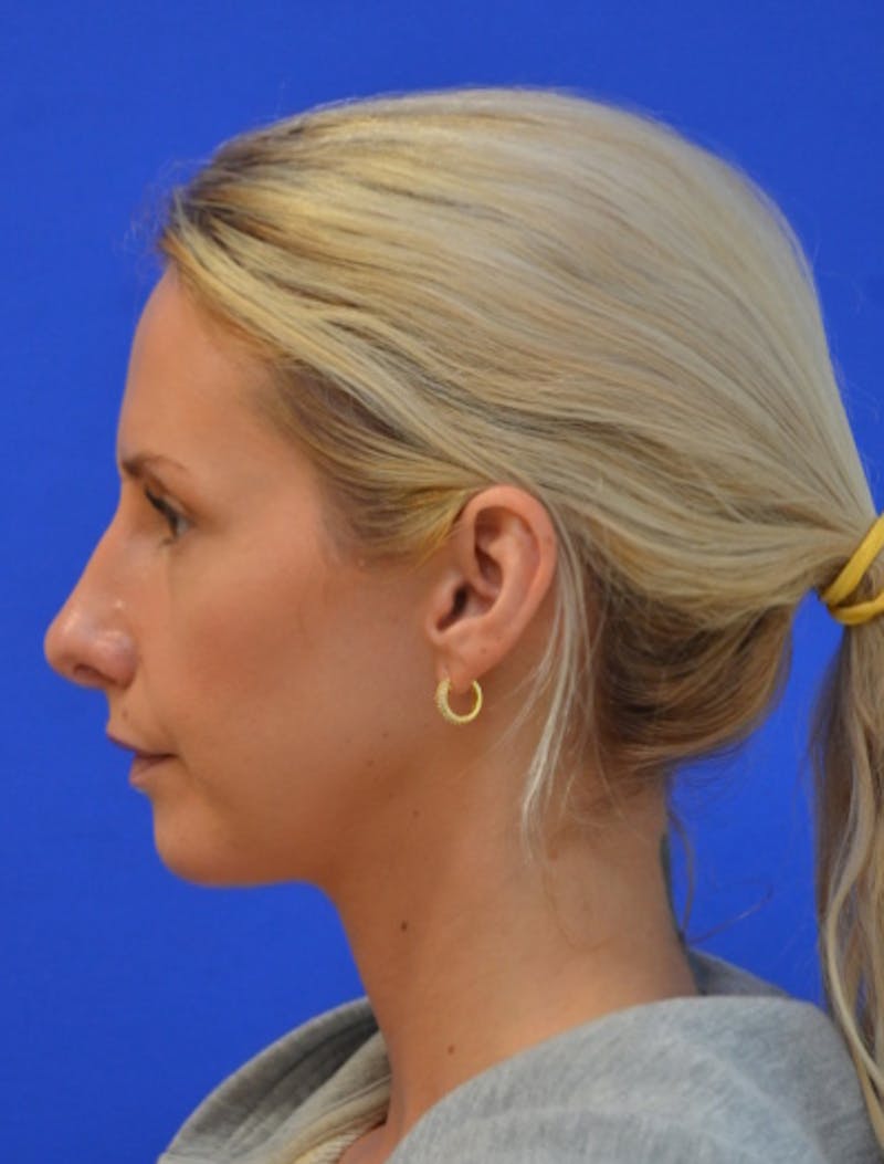 Rhinoplasty Before & After Gallery - Patient 293733 - Image 8