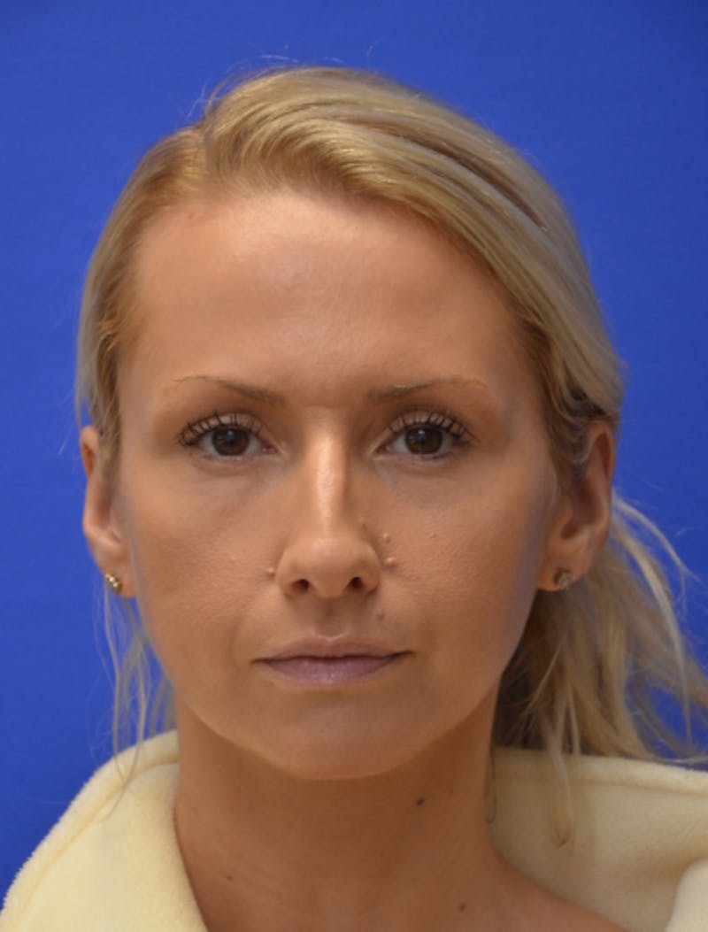 Rhinoplasty Before & After Gallery - Patient 293733 - Image 9
