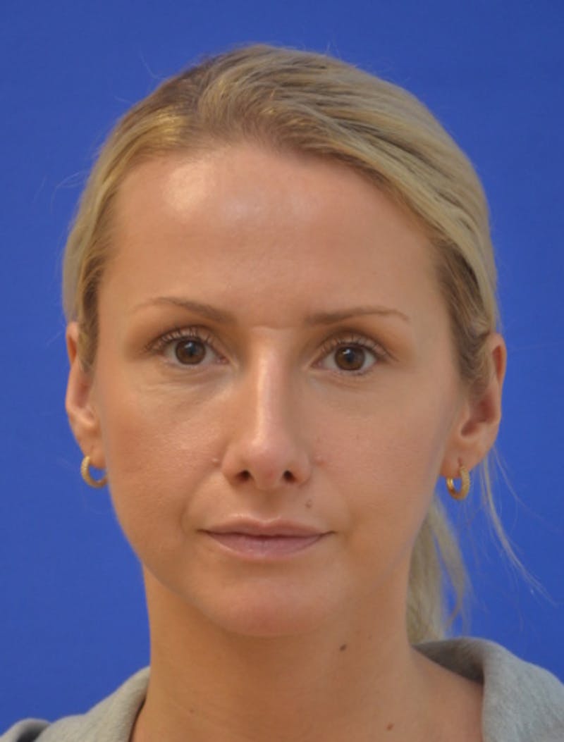 Rhinoplasty Before & After Gallery - Patient 293733 - Image 10