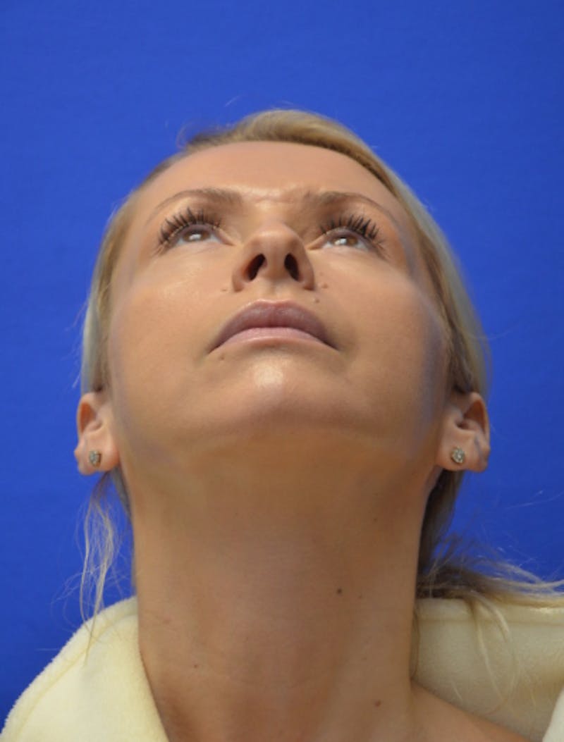Rhinoplasty Before & After Gallery - Patient 293733 - Image 11