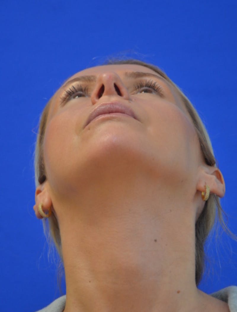 Rhinoplasty Before & After Gallery - Patient 293733 - Image 12